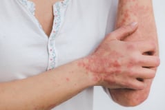 skin diseases